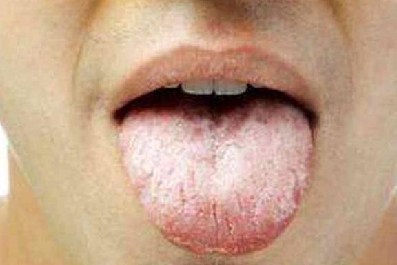 控制|糖尿病人不妨观察下舌头，若没发现这3种情况，说明血糖控制良好