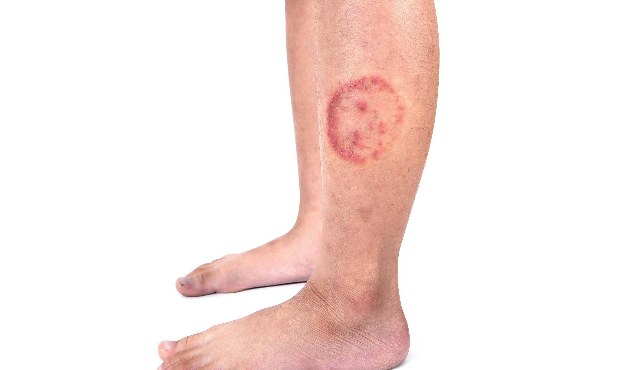 但是,如果你在正常饮食中吃蔬菜和水果,你很少会出现如此严重的症状.