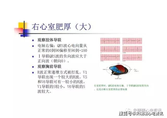 离心性肥大图片