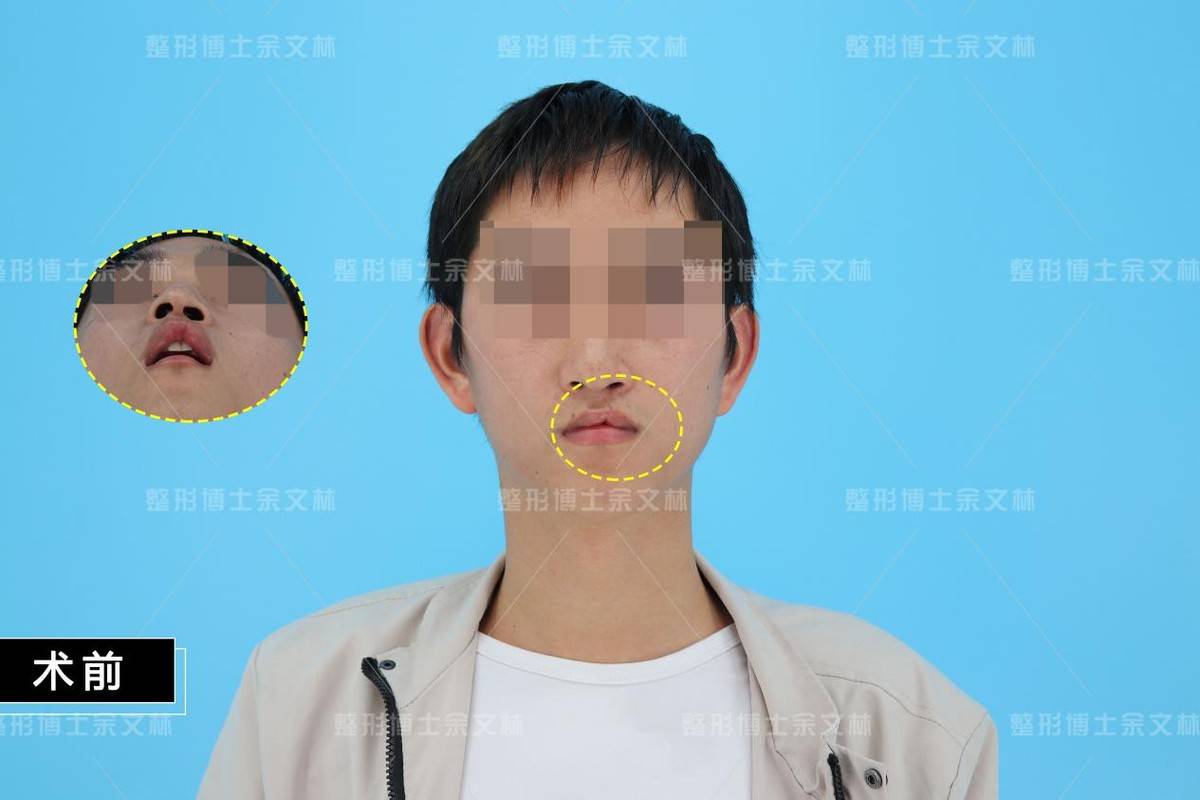 【案例分析】26歲男子紅唇輕微缺損,唇裂二期修復手術過程分析_鼻孔