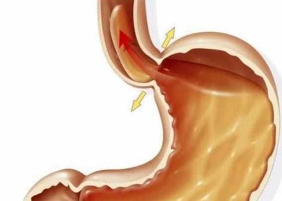 是什么原因引起胃食管反流 ed947b6852914fa7a921abe28a985b89.jpeg