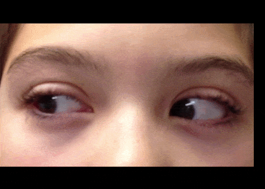 上海眼科专家眼球震颤是什么症状眼球震颤自己能感觉到吗