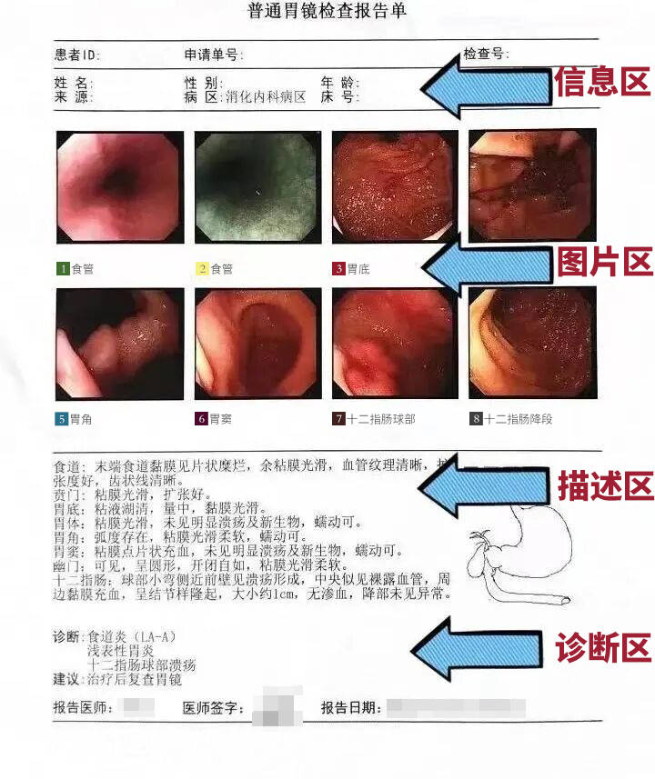 胃出血胃镜报告单图片