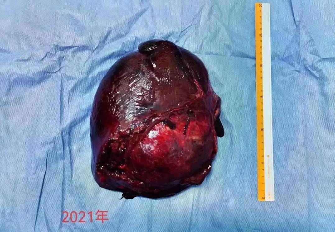 漳州市医院肝胆疝外科再次完成高难度巨大肝癌手术_福建省_恶性肿瘤