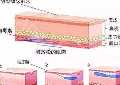 括约肌科普，肉毒素除了能瘦脸 还能用来干什么？