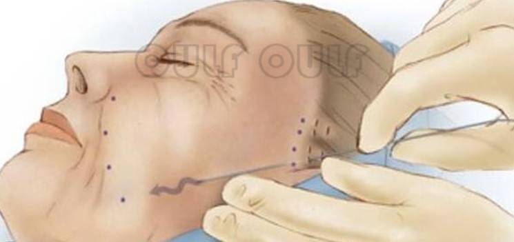 脸部谁知道刚做完线雕脸部有凹凸正常吗？蛋白线面部提升后遗症,好恨!!