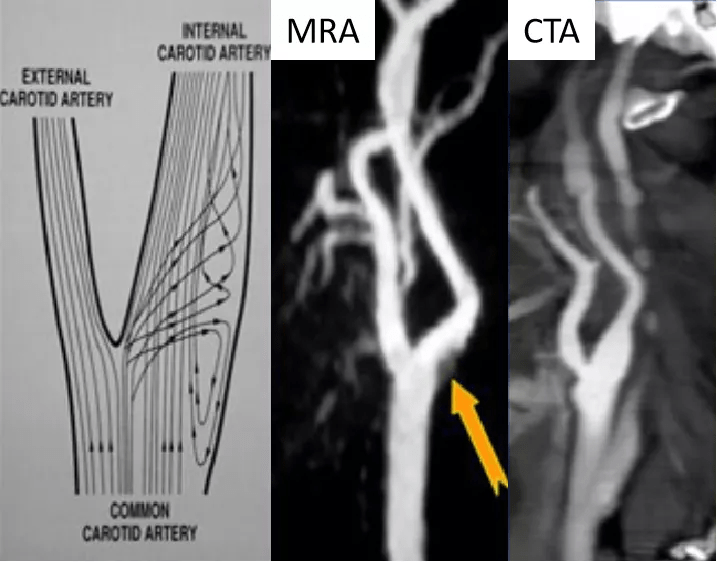 头颈部 CTA 与 MRA 有什么异同点，它们各自有何局限性？_血管_显示_成像