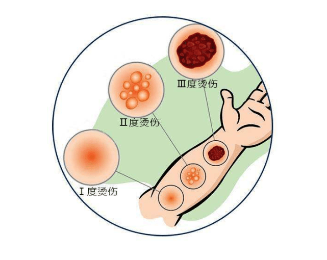 想快速消肿却出现低温烫伤?这些问题你要知道