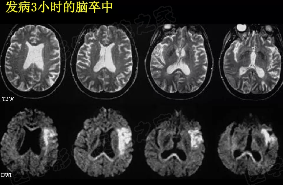 腦梗在磁共振彌散圖像上信號的演變過程