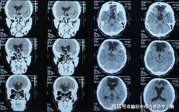 開顱和經鼻蝶2次垂體瘤切除術後顱內感染腦積水長時間腦室引流反覆