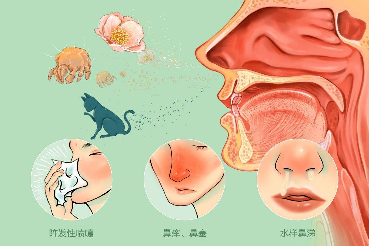 过敏性鼻炎会影响孩子智力记忆力吗