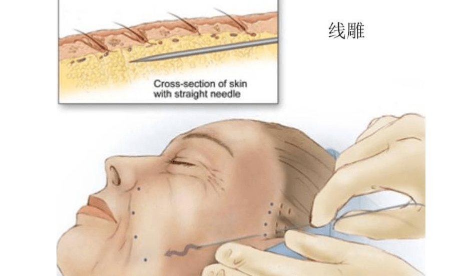 什么科普篇：ppdo线雕是什么线？ppdo线雕维持时间？