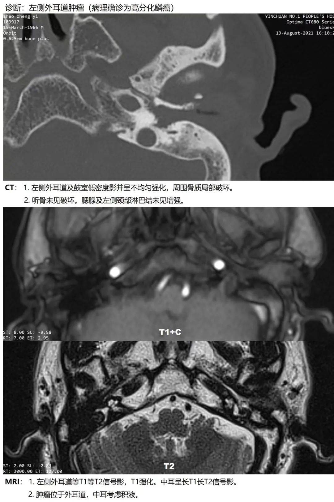银川市一医院耳鼻咽喉头颈外科成功完成一例外耳道恶性肿瘤摘除术