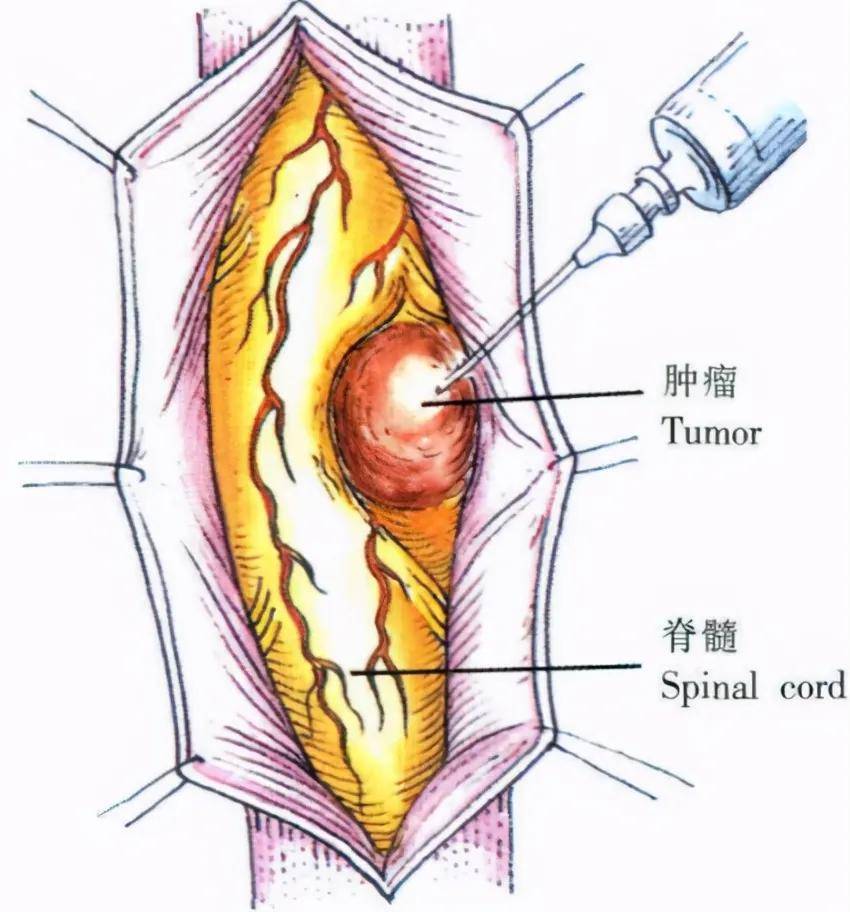 专科医院|这种“瘤”善于伪装成腰椎病 一起揭开它的面具