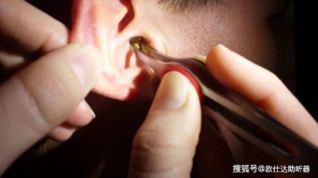 及听力减退;4,其他耵聍栓塞后可诱发外耳道皮肤糜烂,肿胀,肉芽形成等