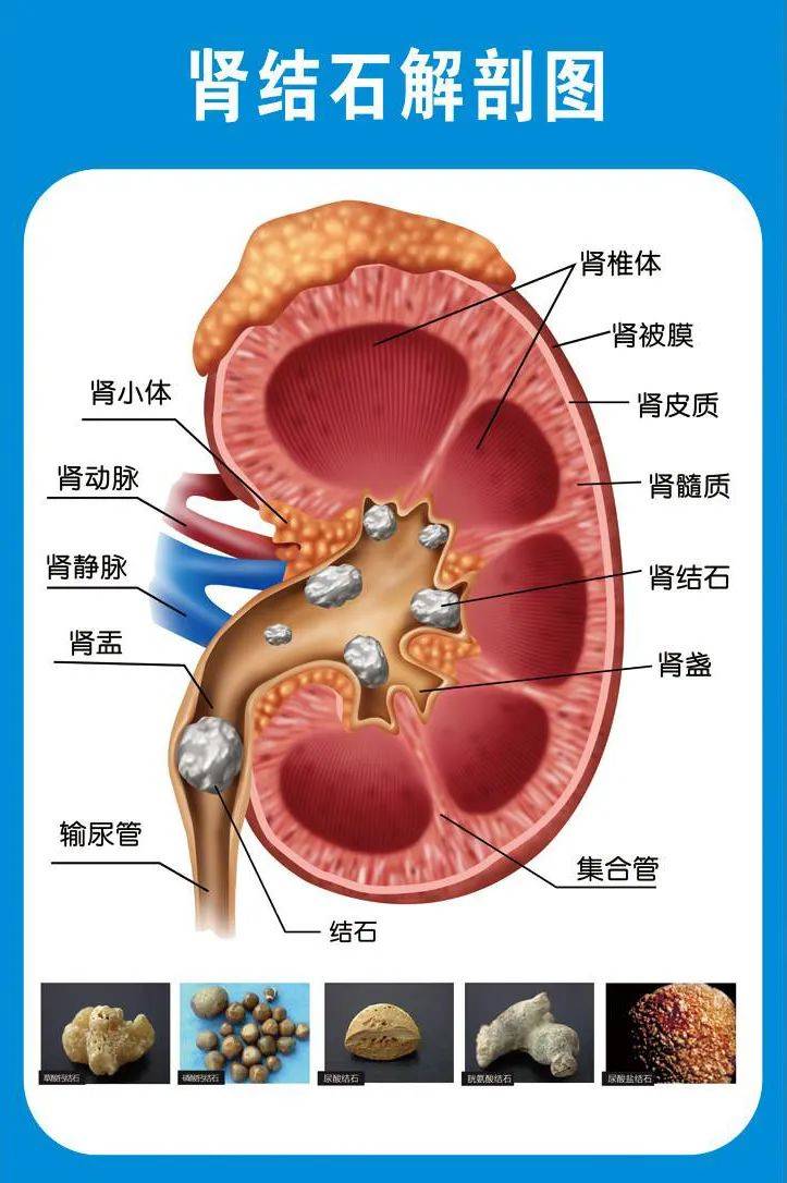 肾结石检查单子图片图片