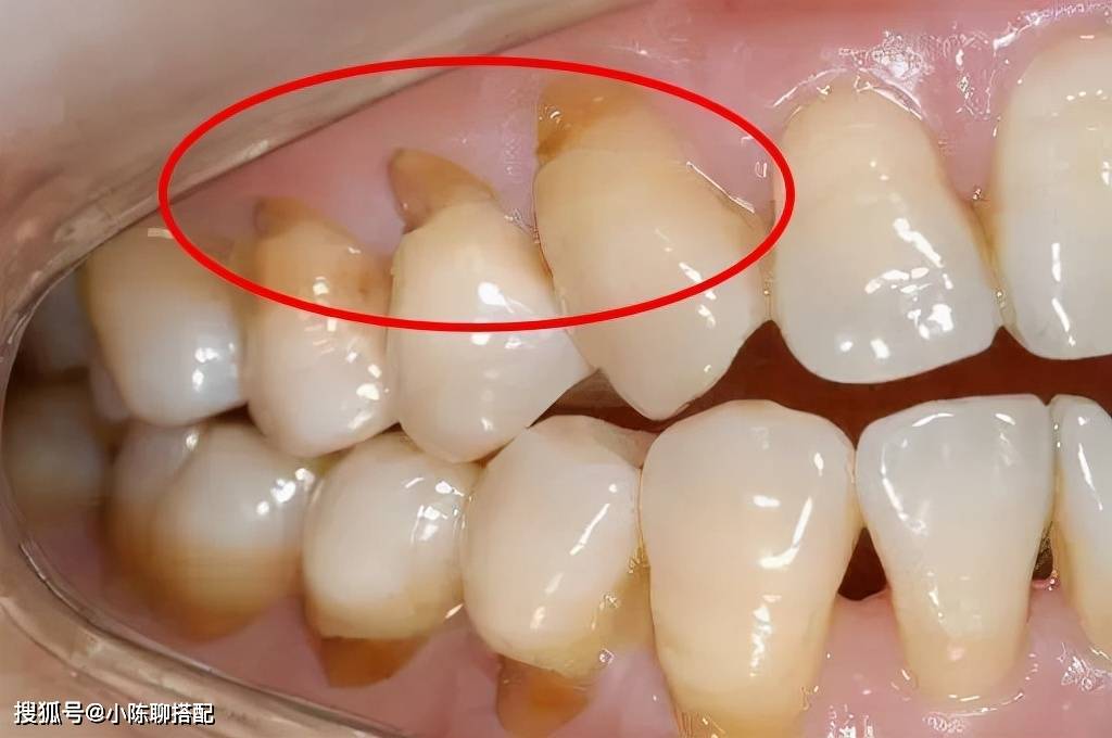 牙龈你以为每天早晚刷牙就够了？日常护牙还需知道这3点
