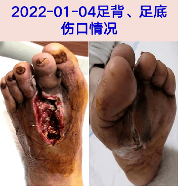 病史|皮肤感染后的并发症，非常震撼