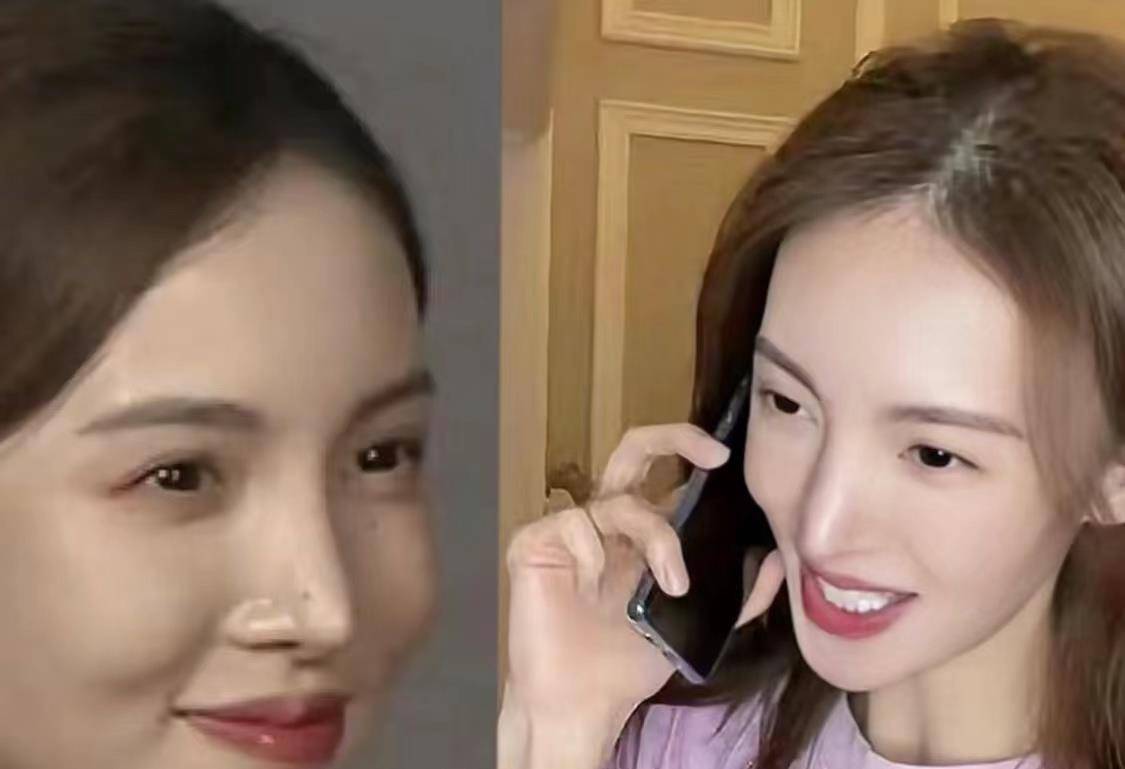 后遗症女明星为了变美，乱整鼻子留下的后遗症，至今悔恨终身