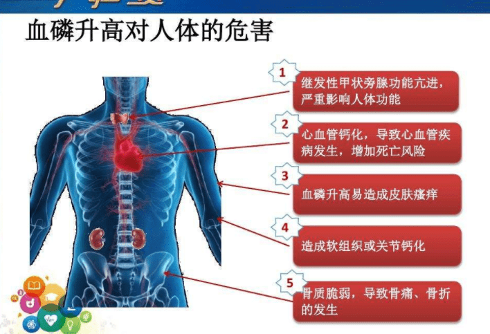 透析患者血磷升高有哪些危害