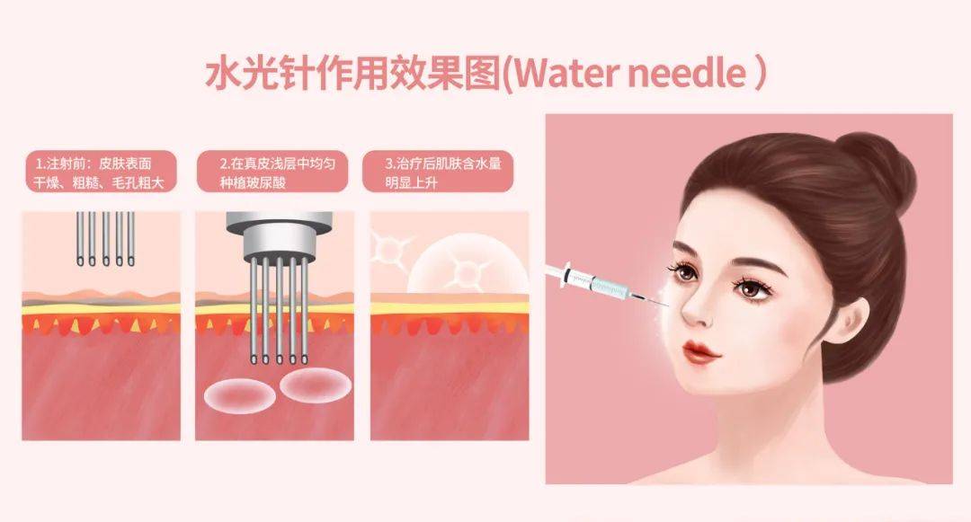 玛吉三个医美项目：水光针、光子嫩肤、热拉提