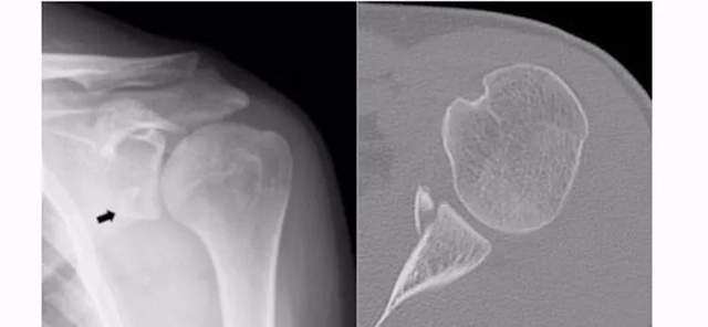 有些病人可能需要做ct,甚至mri檢查,瞭解是否合併有肩胛盂骨折,肩袖