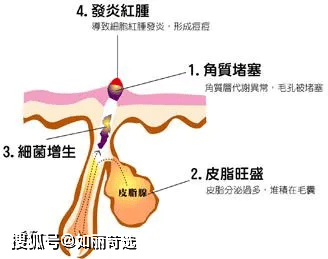 治疗痘痘只能靠医美手段改善吗？