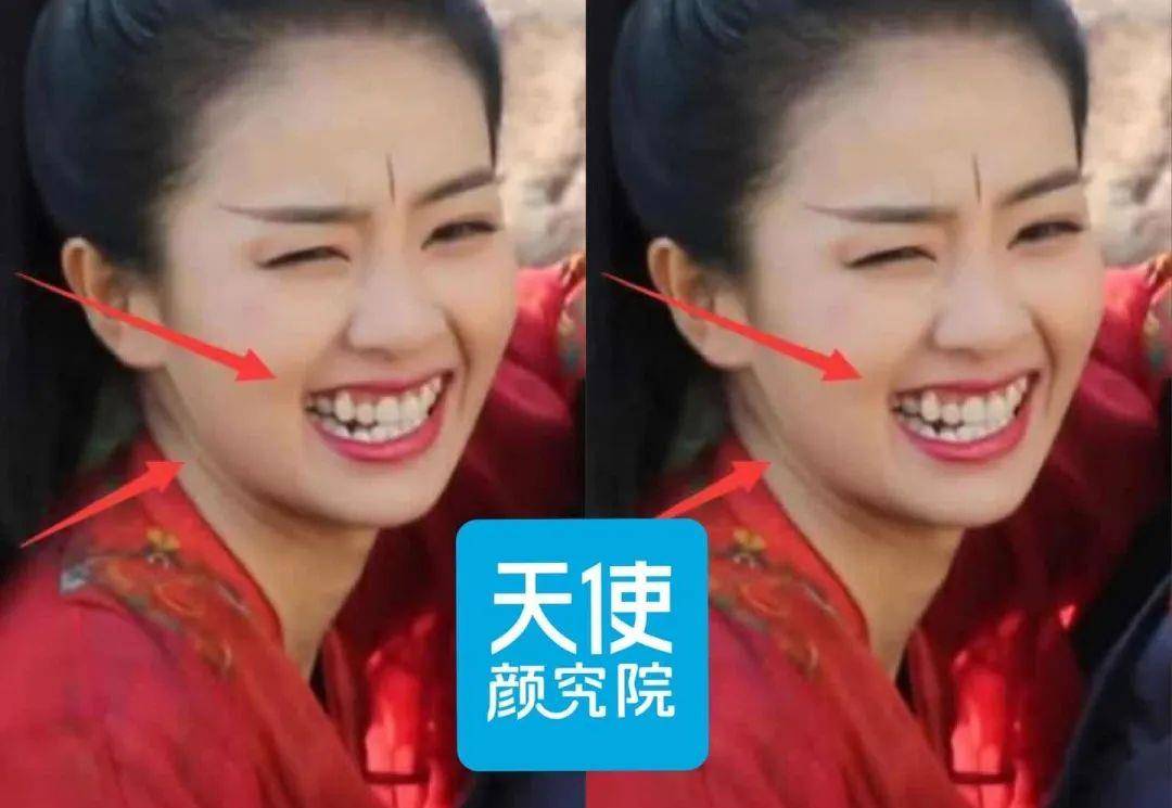 小天关晓彤是不是do脸了？凹脸变得幼态又平整