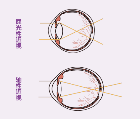 眼底|孩子近视，别只关心度数--眼轴眼底全面监测更科学！