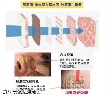 治疗痘痘只能靠医美手段改善吗？
