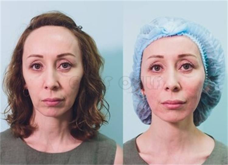 严重真相:7d聚拉提会加速衰老吗、7d聚拉提一次效果维持多久?