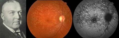 经验分享青少年型遗传性黄斑变性斯塔加特病stargardts病简介
