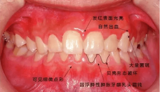 新都华圣艺口腔医院科普为啥牙龈炎早期时不能及时被察觉