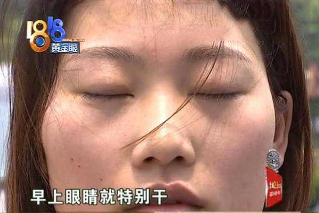 要求女子花3万整眼睛，做完手术后怒曝光：我晚上睡觉眼睛都闭不上！