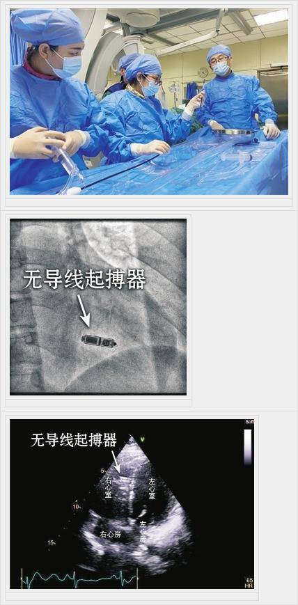 第三心血管内科病房自主完成无导线胶囊起搏器植入