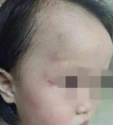 职业|2岁女童在幼儿园被打伤，看到涉事女老师的理由，评论区沦陷了！