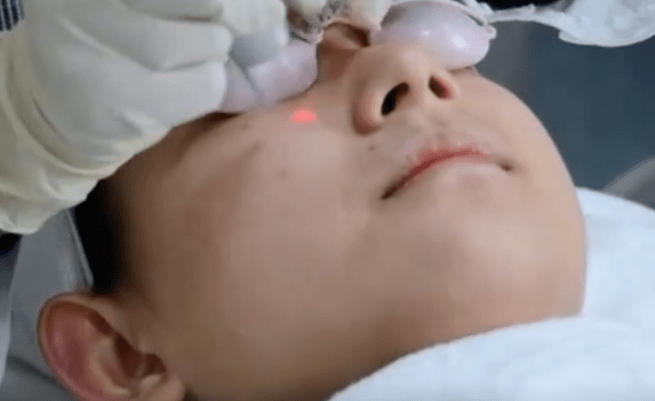 治疗医美科普 | 光子嫩肤、点阵激光、去黑激光、去红激光等术后护理注意事项！