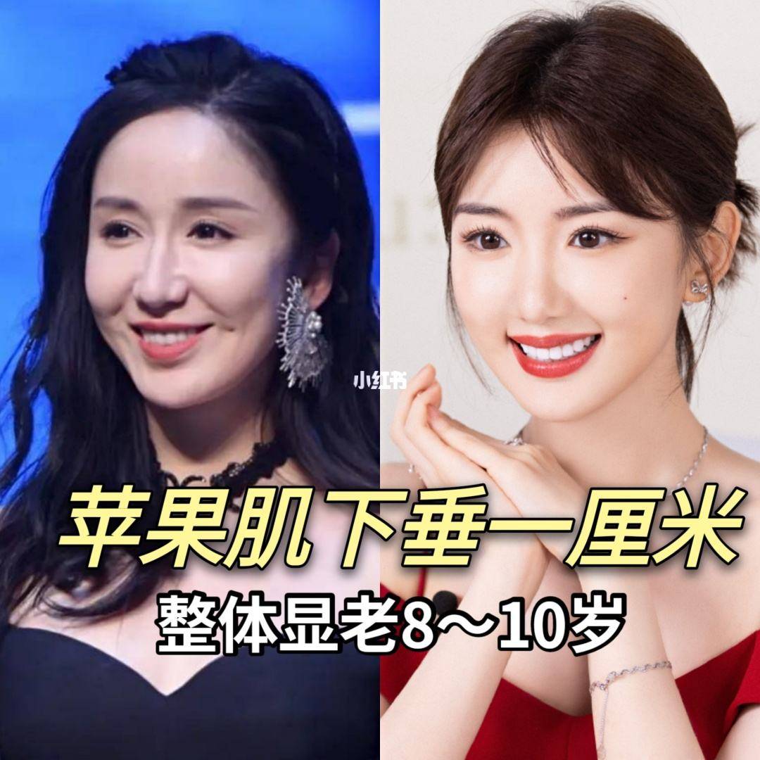 苹果肌下垂提升的好方法