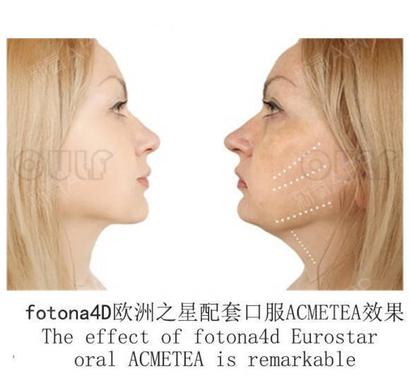 治疗4d fotona pro欧洲之星做完多久有效果、闺蜜的美我一点都不意外