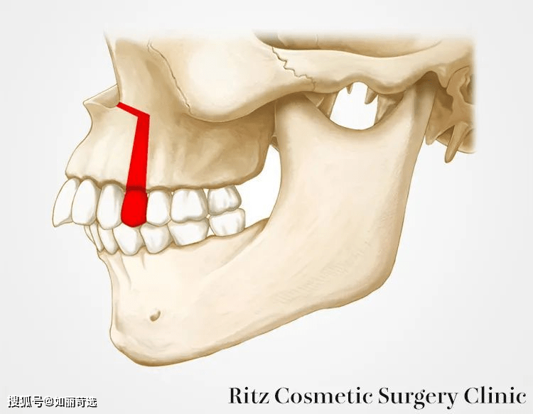 同理,同属于颌前部截骨术手法的下颌分节骨切术也是这样