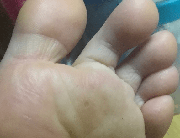 我们的脚指甲大部分都是粉红色的,硬度适中,不爱破裂,如果肝脏出了