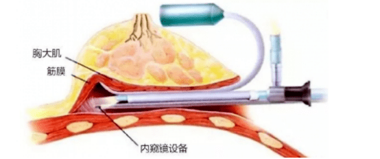 进行完美体态不可缺少的美胸，这样塑造