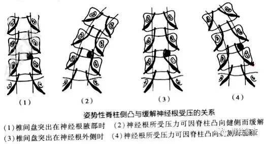 腰椎间盘突出症导致的身体歪斜称为代偿性脊柱侧弯