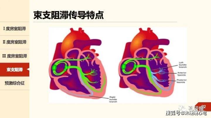 不可錯過丨 心臟傳導異常所致心律失常(精美幻燈)_左束支_束支和_系統