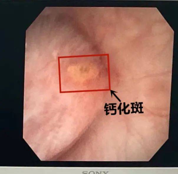 而草酸钙生长成石的理想之所就在randall斑上