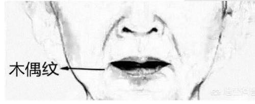 支撑力木偶纹是怎么形成的?——唇部抗衰1