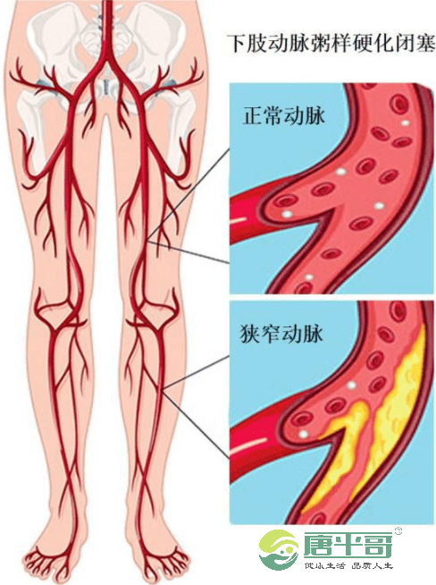 血管|糖尿病这几个危害影响全身，千万不能忽视