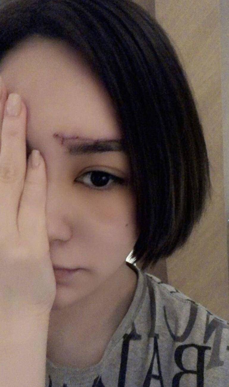 因煎香肠致二级烧伤,白嫩脸颊满是水泡超明显_黄凯怡_女明星_因为