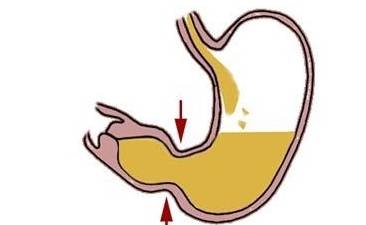 折磨人的膽汁反流性胃炎出現了,若能做好這件事