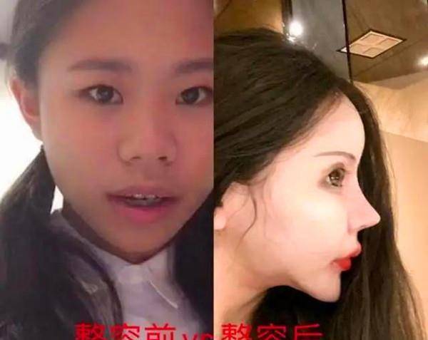 漂亮那个13岁就整容的网红女孩，3年整了60次，如今现状如何？